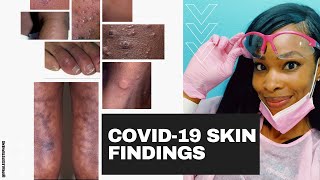 The 6 Most Common COVID19 Skin Rashes [upl. by Tavy]