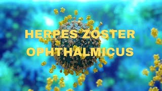 Herpes zoster ophthalmicus  OPHTHALMOLOGY  NEETPG  virus  keratitis [upl. by Ssegrub998]