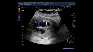 Early first trimester twin Pregnancy  08 weeks [upl. by Rotberg]