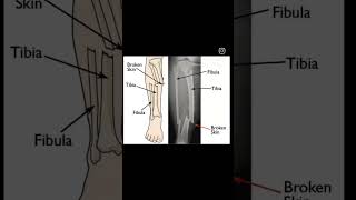 Tibia Fibula Fracture [upl. by Oeniri]