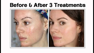 Microneedling Update Before amp After 3 Treatments [upl. by Lazor]