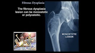 Fibrous Dysplasia  Everything You Need To Know  Dr Nabil Ebraheim [upl. by Oriel]