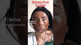 THIS IS CRAZY  Extreme Phenol Peel For Acne Scarring [upl. by Ahsonek]