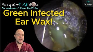 GREEN INFECTED EAR WAX 249 ear earwax earwaxremoval earcleaning asmr fyp foryou satisfying [upl. by Lleryd916]