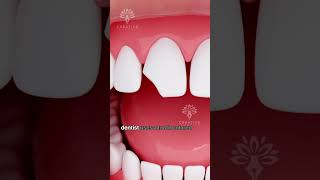 How Does Bonding Fix a Chipped Tooth shorts tooth  Creativelearning3d [upl. by Yaral281]