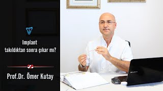 İmplant Takıldıktan Sonra Çıkar Mı  Prof Dr Ömer Kutay [upl. by Michella410]