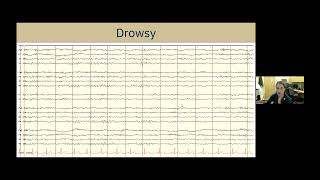 Understanding EEG A Practical Guide for Patients and Families [upl. by Zel977]