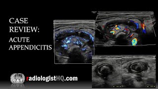 Appendix Explained  Expert Surgeon Dr Pushkar Galam  Causes Symptoms Treatment lifestyle [upl. by Niltak445]