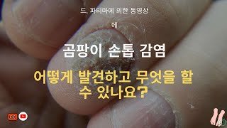 곰팡이 발톱 감염을 어떻게 발견하고 대처해야 할까요 FUNGAL NAIL Infection [upl. by Blus402]