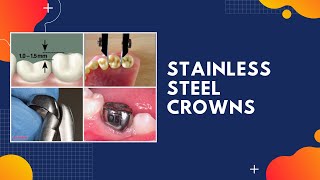 PEDIATRIC DENTISTRY  STAINLESS STEEL CROWNS [upl. by Achorn]