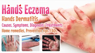 Eczema Hands overview causes sign and symptoms diagnosis treatment home remedies FAQs extend [upl. by Sardse465]