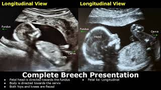 Fetal Presentations Ultrasound Images  CephalicBreechFrankFootlingFunic Fetus  Fetal Lie USG [upl. by Pernick]