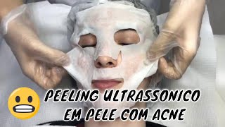 Como funciona o PEELING ULTRASSONICO [upl. by Damha]