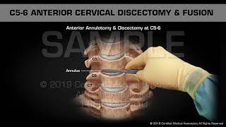 Anterior Cervical Discectomy amp Fusion at C56  Medical Animation [upl. by Itnahs]