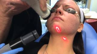 Recovery After CO2 Laser Facial [upl. by Emera]