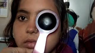 COVER TEST Alternate esotropia  ocular examination 👁‍🗨 [upl. by Yreneh]