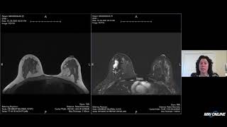 Breast MRI BIRADS Assessment [upl. by Grewitz343]