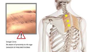 Trigger Point Release  Shoulder Pain  Rhomboids [upl. by Dabbs]