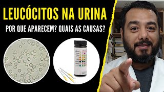 Leucócitos altos na urina o que significa  E com urocultura negativa ausência de bactérias [upl. by Buckie815]