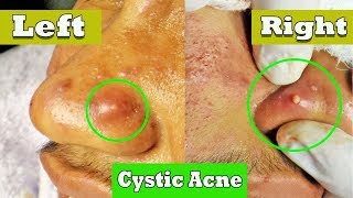 Drainage de lacné kystique sur le nez  cystic acne extraction [upl. by Portwin]