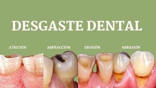 Desgaste dental  atrición abfracción  erosión y abrasión [upl. by Rehctaht]