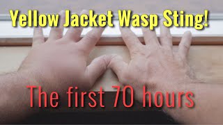 YELLOW JACKET WASP STING The first 70 hours [upl. by Troy]