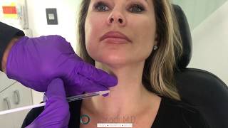 Botox for Neck Bands Platysmal Bands Dr Amir Moradi San Diego California Moradi MD [upl. by Sillyrama682]