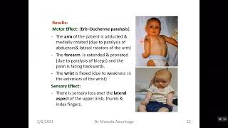 Lesion of Brachial plexus [upl. by Piotr]