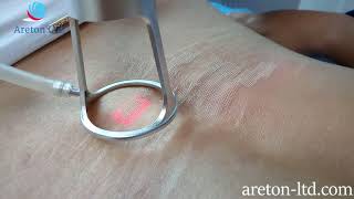 Stretch MarksTreatment using The Areton Fractional CO2 Laser [upl. by Greenman]