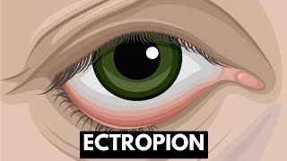 Ectropion Causes Symptoms Complications And Treatment [upl. by Yema]