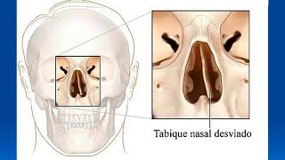 Causas y tratamientos del tabique desviado [upl. by Imyaj]