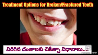 విరిగిన దంతాల చికిత్సా విధానాలు Treatment options for Broken  Fractured teeth drlalithakota6608 [upl. by Cand]