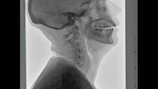 Cineradiography For Cranio Cervical Instability [upl. by Kceb]