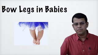 Bow legs in Babies [upl. by Oiziruam396]