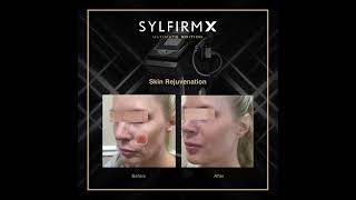 Sylfirm X Skin Rejuvenation [upl. by Aned]