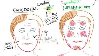 Acne Vulgaris causes subtypes and ttt [upl. by Tilla]