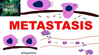 NEOPLASIA 8 INVASION AND METASTASIS Mechanisms Pathways of Spread [upl. by Neyugn]