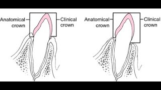 Differences between the anatomical crown of teeth and the clinical crown of teeth [upl. by Haakon275]