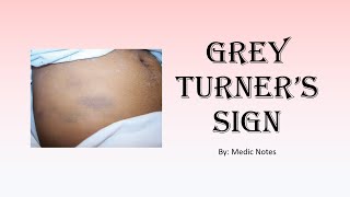 Grey turner sign  causes pathophysiology sign value [upl. by Halueb962]