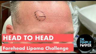 Head to Head Forehead Lipomas Challenge  Challenger 1 [upl. by Naitsabes]