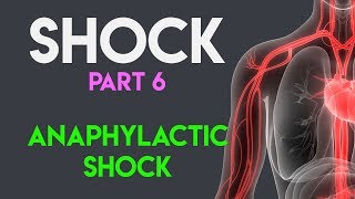 Anaphylactic Shock  Shock Part 6 [upl. by Neih425]