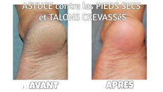 ASTUCE Traitement Efficace contre les Pieds Secs et Talons Crevassés [upl. by Bowman575]