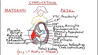 Preterm Premature Rupture of Membranes pprom and Chorioamniotis [upl. by Gati]