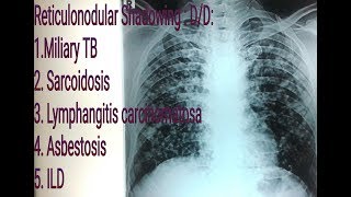 Reticulonodular shadowingopacity on Chest X Ray  Miliary Tuberculosis VS Sarcoidosis [upl. by Supat]