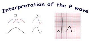 Interpretation of the P wave [upl. by Lennon]