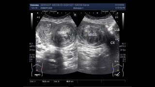 A Large Fibroid with a large Ovarian Cyst [upl. by Auhsej]