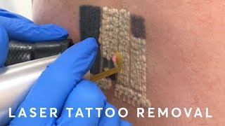 Laser Tattoo Removal PAIN RESULTS amp PROCEDURE [upl. by Yssak380]