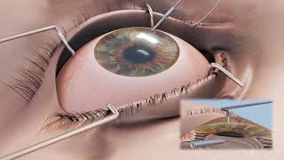 Corneal amp Trephines Cornea Graft Transplant Surgical Procedure Cornonet Eye [upl. by Nyrraf877]