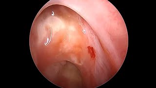 Endoscopy of Portal to BRAIN within NOSE in a AWAKE patient [upl. by Lurette]