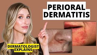 Dermatologist Explains Perioral Dermatitis What it Looks Like Causes amp Treatments  Dr Sam Ellis [upl. by Thetisa]